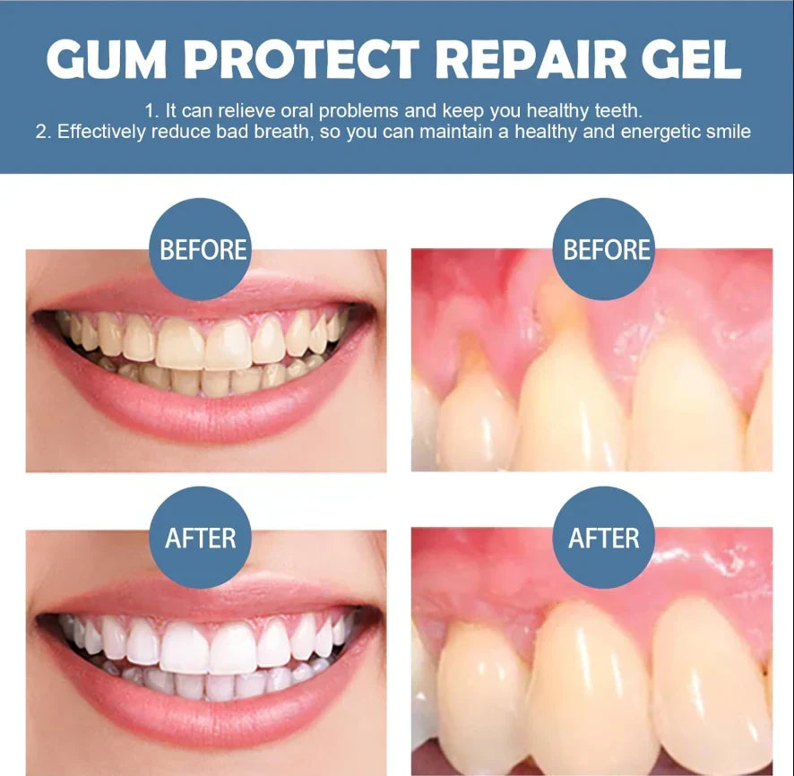 【New upgrade】Caelvya Gum Protect Dental Repair Gel【3 tubes/box】